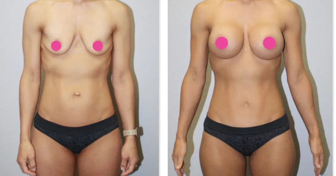 A woman with breast implants before and after surgery.