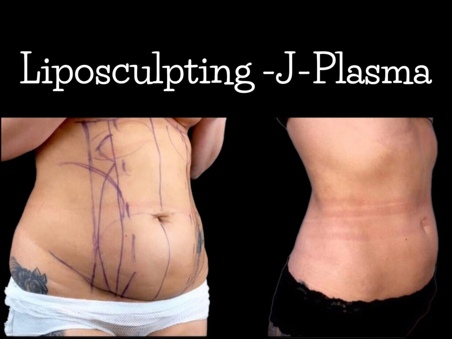 Liposculpture-j-plasmon