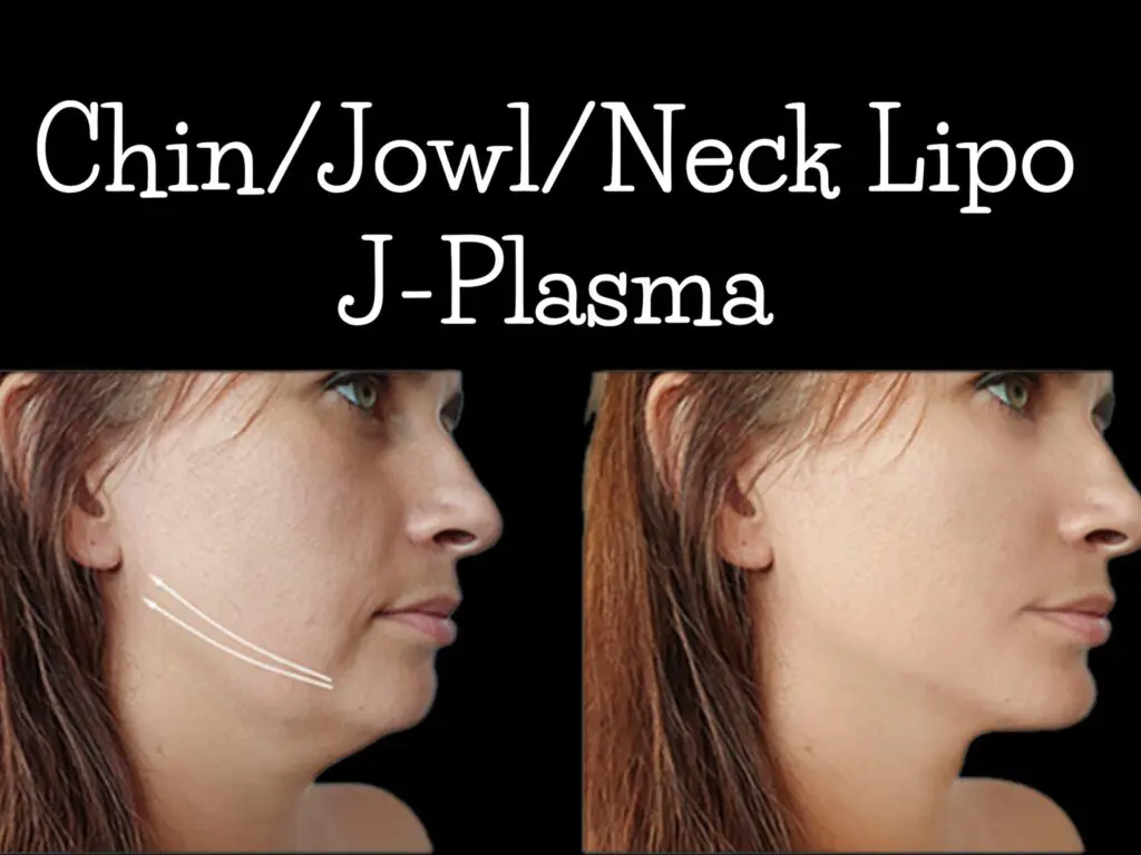 A woman 's face and neck before and after surgery.