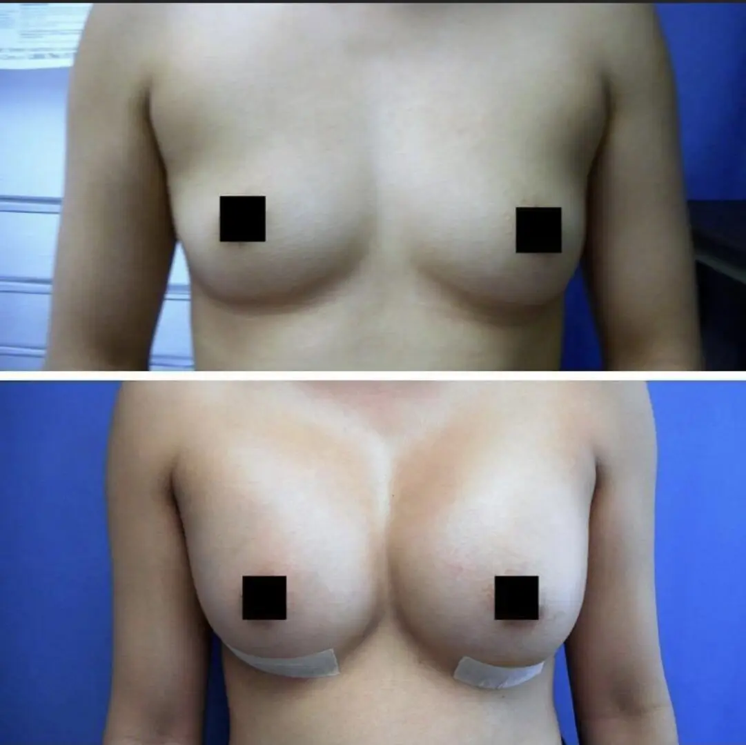 A before and after picture of breast augmentation surgery.