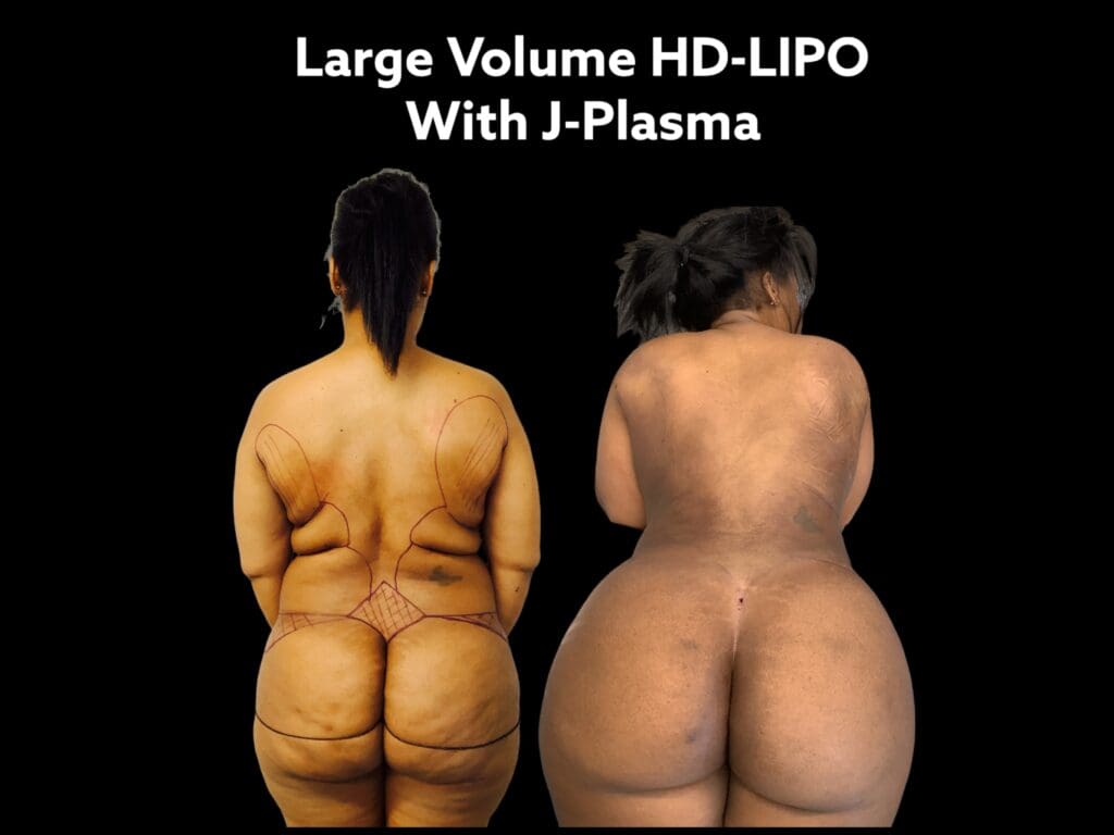 A woman with large volume hd-lipo and j-plasma
