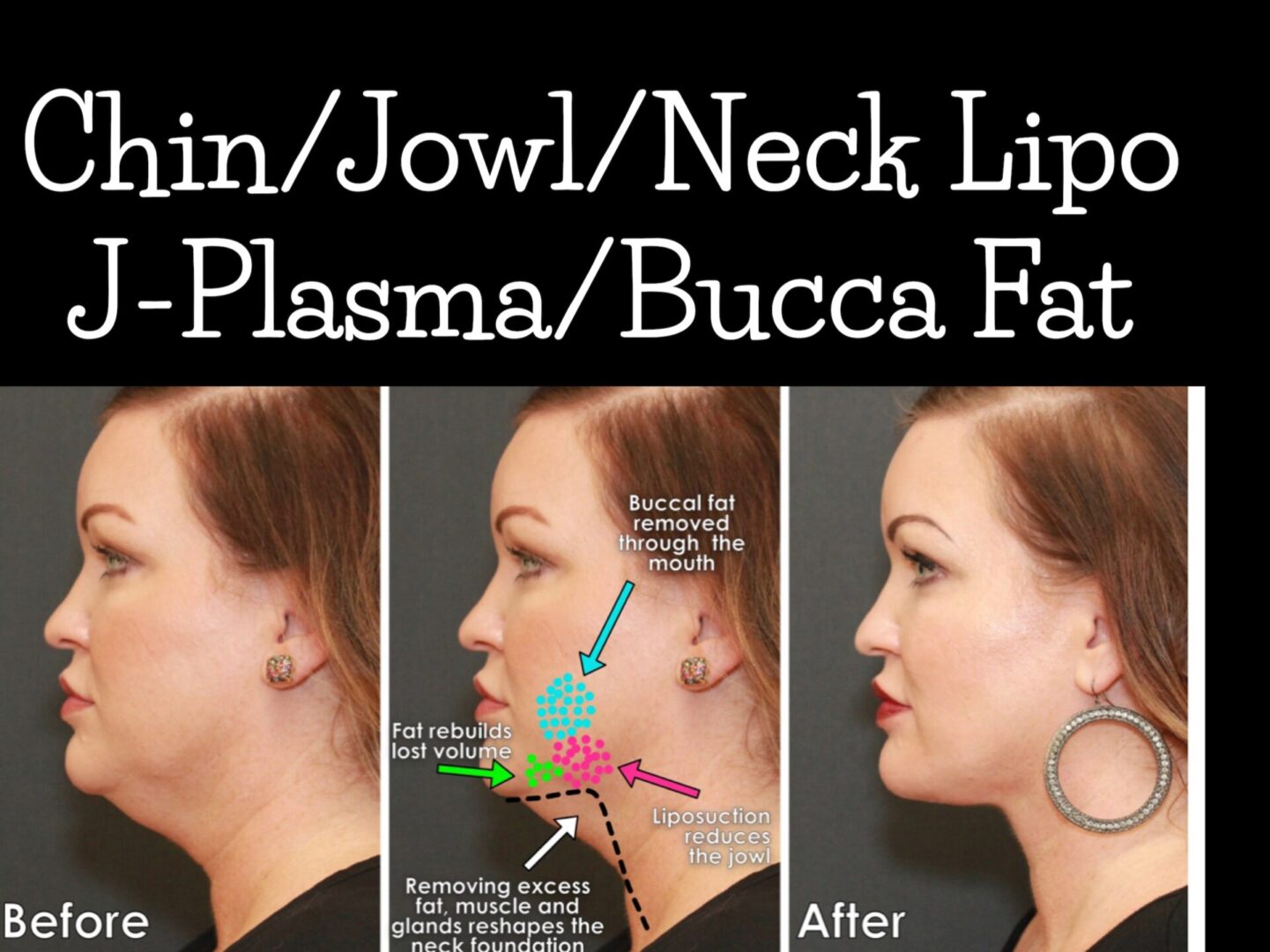 A woman 's face with different stages of chin / jowl / neck liposuction.