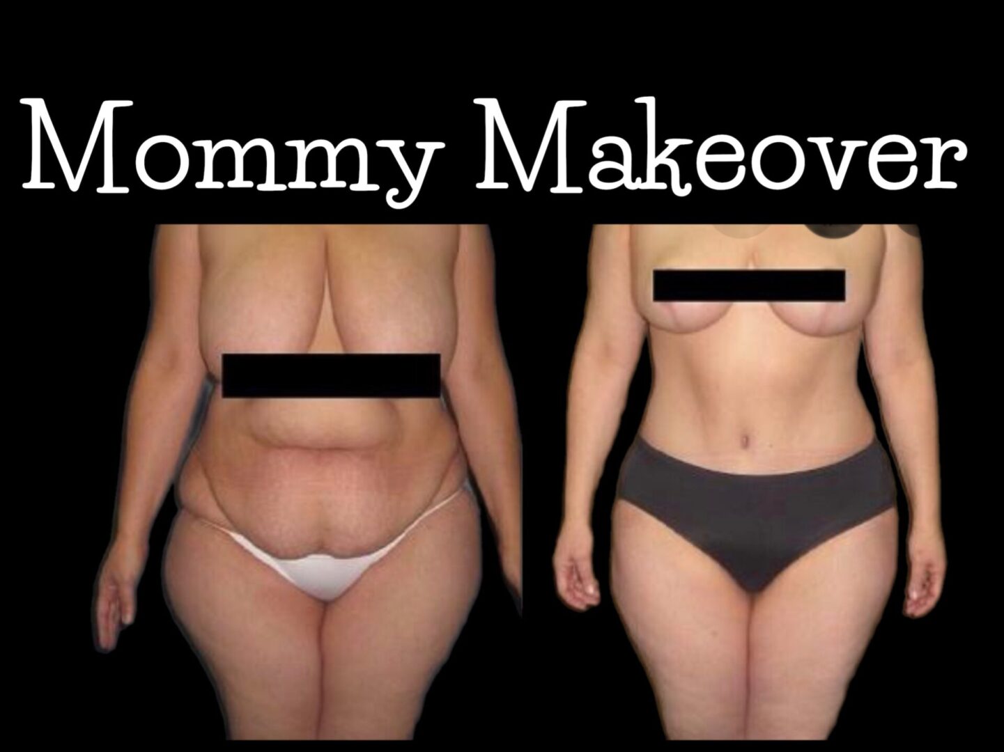 A woman 's body before and after weight loss.