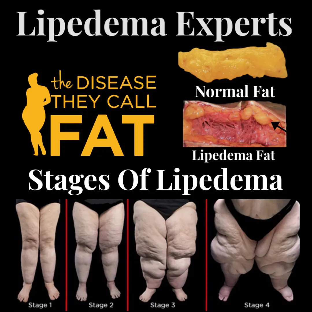 A picture of the stages of lipedema.