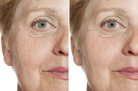 A woman 's face before and after using the same procedure.