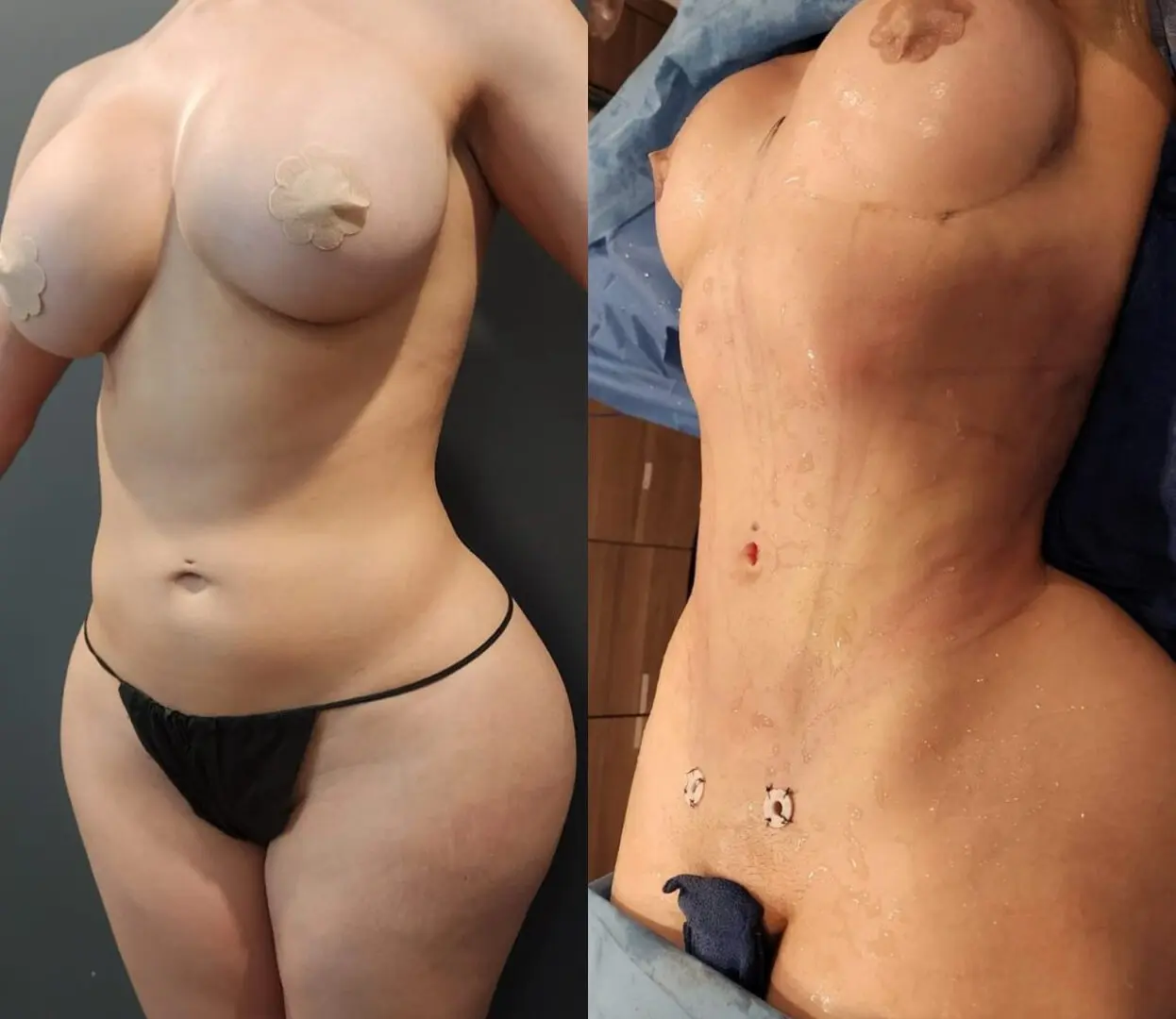 A woman going through surgery for reducing fat