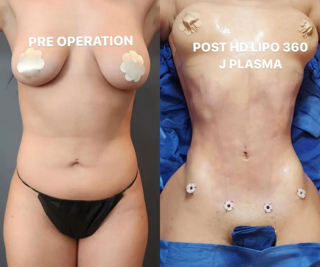 Before and after pictures of a female body for surgeries